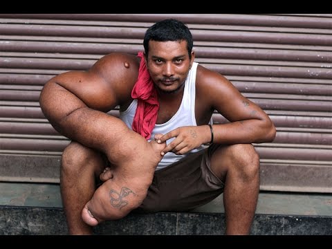 مرض نادر يجعل ذراع شاب هندي أكبر من ساقه