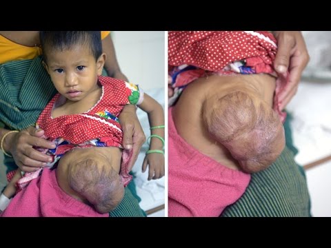 شاهد ولادة نادرة لطفل هندي بأمعاء خارج جسمه