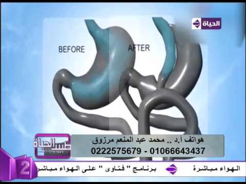تعرف على تفصاصيل عملية تحويل المسار المصغر ومضاعفاتها