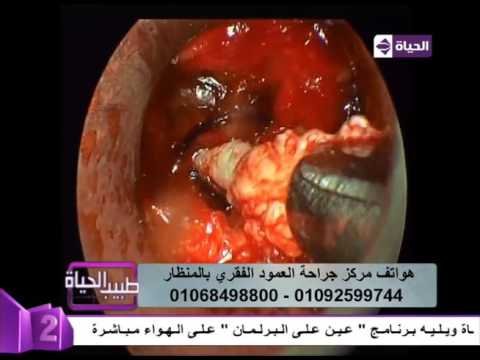 كيفية جراحة العمود الفقري بالمنظار