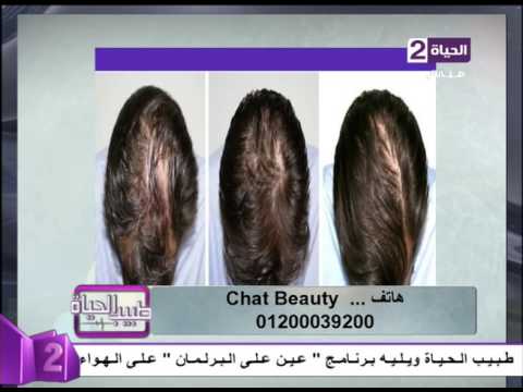 تقنية النانو في علاج تساقط الشعر