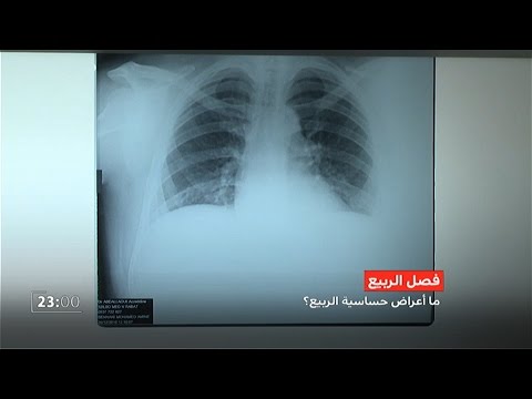 أعراض حساسية فصل الربيع والوقاية والعلاج