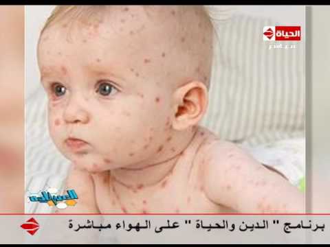 شاهد شكل مرض الجدري في الجلد