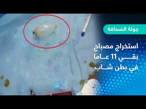 شاهد استخراج مصباح بقى 11 عامًا في بطن