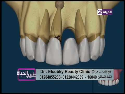 شاهد الفرق بين التركيبات الثابتة وزراعة الأسنان