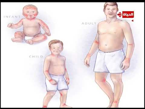 شاهد بالصور توضح أنواع الحساسية عند الأطفال