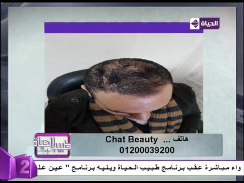 شاهد نتائج مبهرة بعد استخدام تقنية النانو لعلاج الصلع