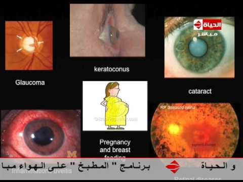 شاهد الحالات التي لا يصلح فيها عملية الليزك