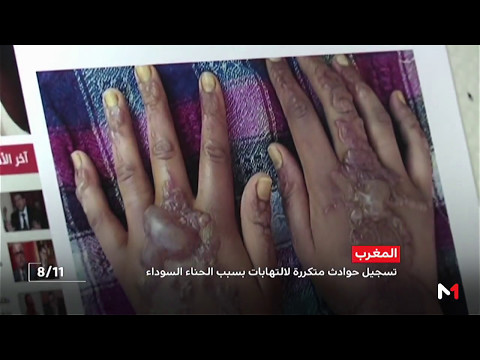 شاهد تسجيل حوادث متكررة للالتهاب بسبب الحناء السوداء في المغرب