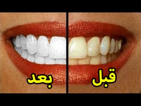 شاهد أسرع 8 طرق لتبييض الأسنان خلال دقائق في المنزل