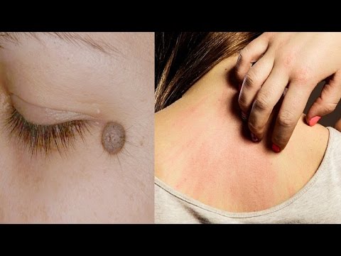 شاهد  علامات مبكرة إن وجدتها في جسمك فإنك مهدد بالسرطان 