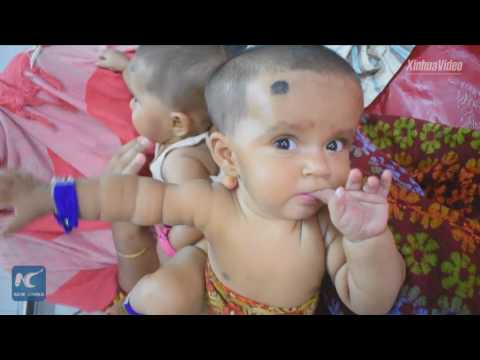 فصل توأم ملتصق في بنغلاديش بمشاركة 30 طبيبًا