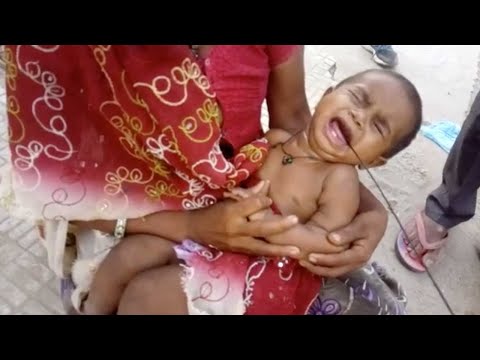 سلك شمسية يخترق حلق طفل صغير