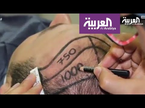 تعرف على جديد إجراءات زراعة الشعر