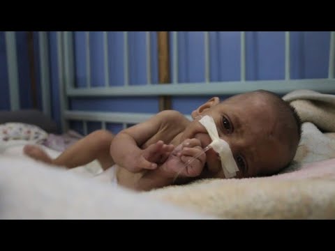 شاهد سوء التغذية يهدد أطفال الغوطة الشرقية