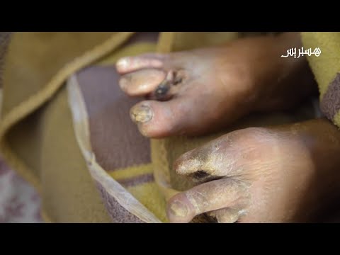 شاهد داء يلتهم قدمي رجل وسط عجزه وحاجته إلى المساعدة