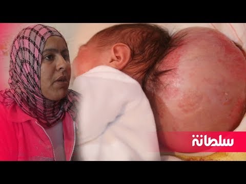 شاهد أب مغربي يرزق بطفلة مولودة برأسين