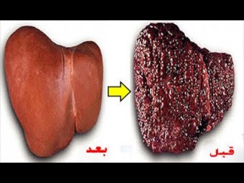 لن تحتاج بعدها إلى الخضوع لغسيلها في المستشفى