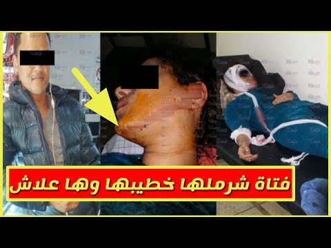 شاهد شاب يعتدي على خطيبته ويتسبب في تشويه وجهها