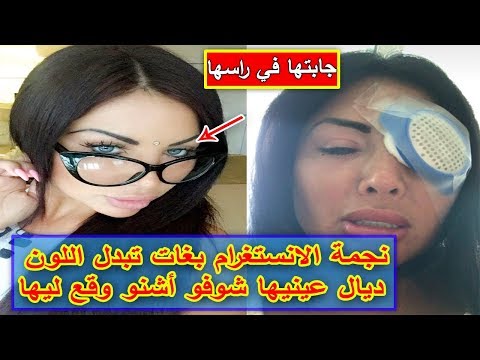 شاهد النجمة نادين برونا تُصاب بالعمى