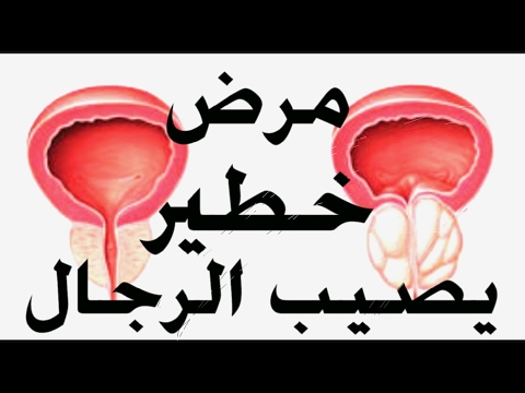 شاهد اكتشاف علاج جديد لمرض البروستاتا ونصائح للوقاية منها