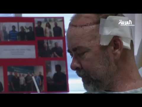 بالفيديو زراعة جمجمة وفروة رأس لمريض بالسرطان