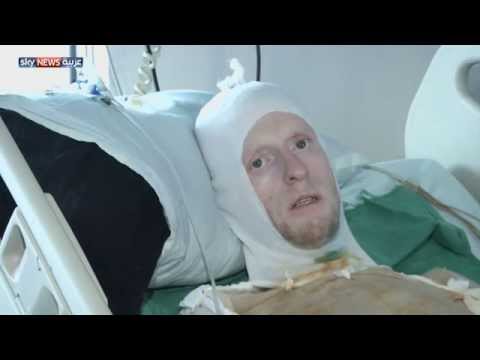 حروق يوسف ومحمد تصل إلى 80 من الجسد