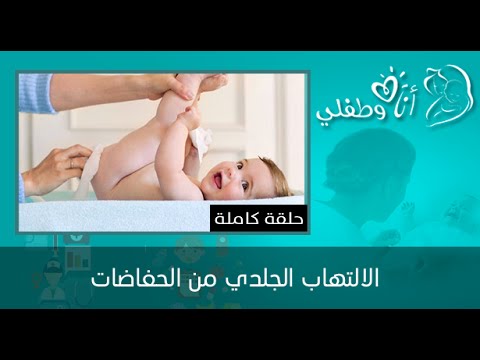 شاهد الحفاضات أحد أسباب الالتهاب الجلدي للأطفال