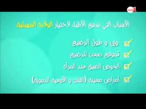 بالفيديو أسباب اختيار الأطباء للولادة القيصرية