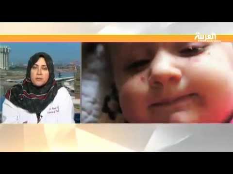 الجدري فيروس معدٍ يصيب الأطفال بشكل خاص