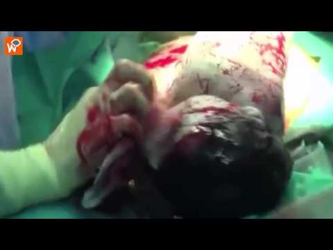 بالفيديو  لحظة ولادة طفلة سورية أصيبت بشظايا