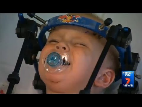 إعادة توصيل رأس طفل انفصل فى حادث سيارة