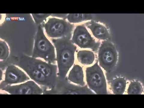 شاهد طريقة علاجية للحد من سرطان البنكرياس