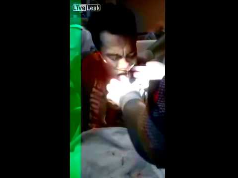 شاهد لحظة إخراج سمكة حية من حنجرة رجل